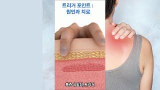 트리거 포인트의 비밀: 진단과 치료의 열쇠 Trigger Points Unveiled: Diagnosis & Treatment