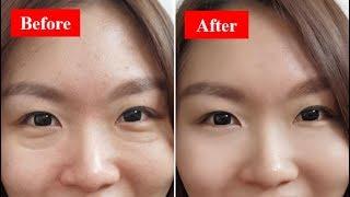 How To Get Rid Of Your Eye Bags Fast & Naturally At Home!