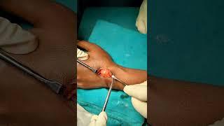 Ganglion cyst removal Surgery in Hyderabad | Dr. Arun Dev, Best Orthopaedic  Surgeon, Kompally