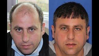 8300 Grafts  | FUE Hair Transplant Before and After