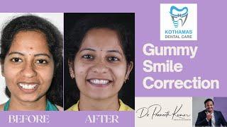 Gummy Smile Correction With Braces - Dr.Praneeth Kumar