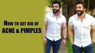 How to get rid of ACNE & PIMPLES | AMIT PANGHAL | PANGHAL FITNESS