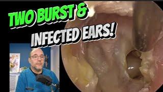 TWO INFECTED AND BURST EARS! 384 ear #earwax #earwaxremoval  #satisfying #foryou #fyp #foryourpage