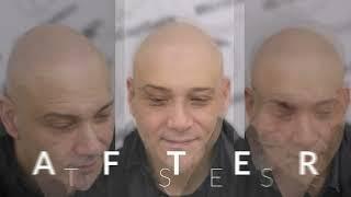 BEST scalp micropigmentation results Toronto Canada