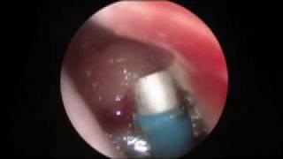 Adenoidectomy