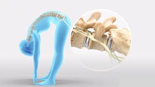 "Why prodisc® L?" Patient Explainer for Total Disc Replacement | Lumbar Spine Disc Arthroplasty