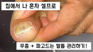 [ 루핀 - Lupine ]집에서 혼자도 무좀 + 내성발톱 관리가 가능하다고?!