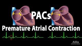 Premature Atrial Contractions (PACs), Animation.