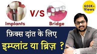 Dental Implants vs. Tooth Bridge क्या है बेहतर? Seraphic Dental Indore