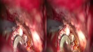 Clip Reconstruction of a Recurrent Anterior Communicating Artery Aneurysm