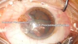 Combined Phaco & Pterygium Excision