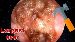 LARGEST Ear Wax Removal, 20 years ear surgery | Doctor Anh