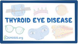 Thyroid Eye Disease- causes, symptoms, diagnosis, treatment, pathology