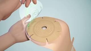 Applying a One-Piece Stoma Bag | Salts Healthcare