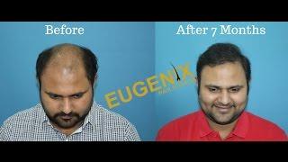 Hair Transplant in Hyderabad, India | Mr. Amlan Acharya Share His Experience at Eugenix