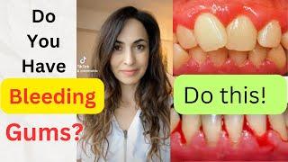 Do You Have Bleeding Gums? Here is what you need to do!