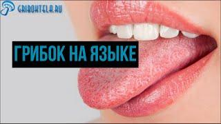 Грибок на языке: причины, виды и симптомы, диагностика и  лечение у взрослых и детей