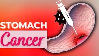 Stomach Cancer, Causes, Signs and Symptoms, Diagnosis and Treatment.