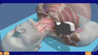 Mixed Reality Simulation of Central Venous Access