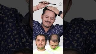 Twelve Months Hair Transplant Results | Latest Fue Technique #shorts #viral #hair transplant