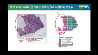 【陈巍学基因】解读用空间转录组和10x单细胞测序分析胰腺导管腺癌的论文