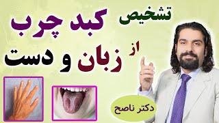 اینطوری از روی زبان و دست، کبد چرب رو تشخیص بده. دکتر ناصح / علائم جگر چرب روی پوست