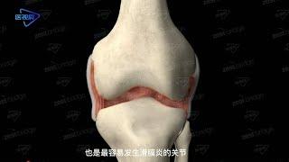 3D Knee synovitis/膝关节滑膜炎