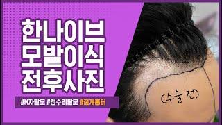 탈모인들을 위한 생착률 높은 #모발이식운동! I 한나이브모발센터