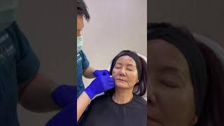 Tear Trough Filler Injection | 泪沟玻尿酸填充 | Dr D Aesthetics Clinic