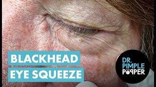 Blackhead Eye Squeeze