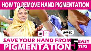 HOW TO REMOVE HANDPIGMENTATION...! -  EXPLANATION IN TAMIL ...!@halinathecuppingclinic