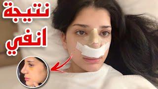 اخيرا نتيجة انفي بعد عملية التجميل.. 