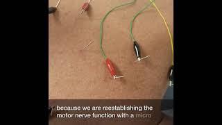 Electro Acupuncture