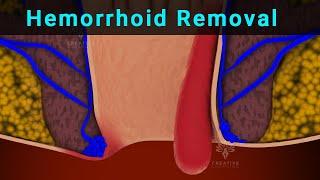 Hemorrhoid Removal Surgery Explained | Hemorrhoidectomy | PilesTreatment - creativeleaning3d