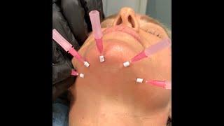 PFRANKMD Threadlifting