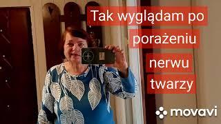 @Mariazaprasza Jak wyglądam po paraliżu nerwu twarzy? Rehabilitacja.Dalszy ciąg.Zapraszam