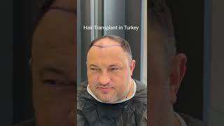 Hair Transplant in Turkey | Hair Transplant Process | Hair Transplant #hairtransplant