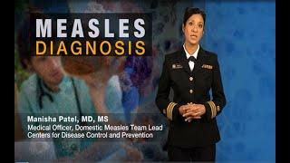 Measles Diagnosis