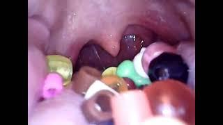 Gulping Down Beads | Mouth + Stomach View! | Endo Cam