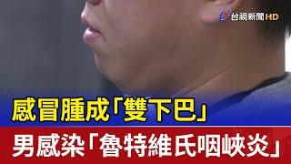 感冒腫成「雙下巴」 男感染「魯特維氏咽峽炎」