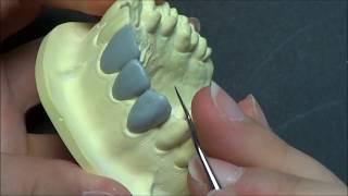 Live wax up - Upper canine