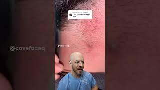 EXTREME ingrown hair! #drreacts #ingrownhair #supersatisfying