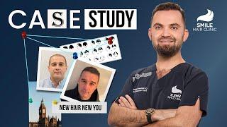 Case Study: 4350 Grafts Hair Transplant | 9-Month Transformation | Smile Hair Clinic