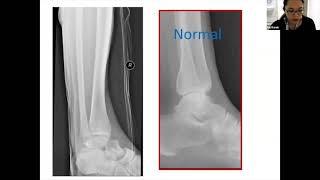 Fundamentals of Orthopaedics Session 15 Part 1 - Talar Fractures