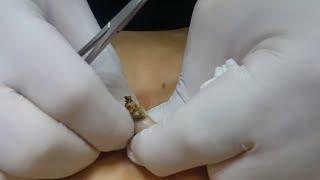 Popping huge blackheads and Giant Pimples - Best Pimple Popping Videos #173