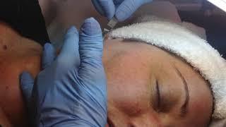 Remove peach fuzz with dermaplaning!