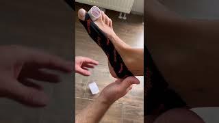 Mechanical correction for advanced Hallux Valgus taping