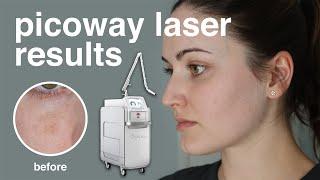 PicoWay Resolve Laser Treatment for Sunspots... My Results!