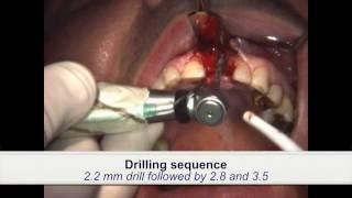 Dental Implant Placement in patient treated with iv bisphosphonates