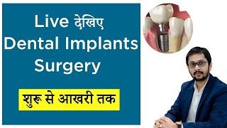 LIVE Dental Implants Surgery-  Start to End all Steps! लाइव देखिए डेंटल इंप्लांट सर्जरी इंदौर में